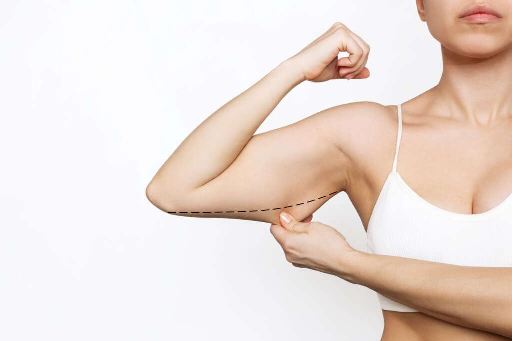 Arm Lift