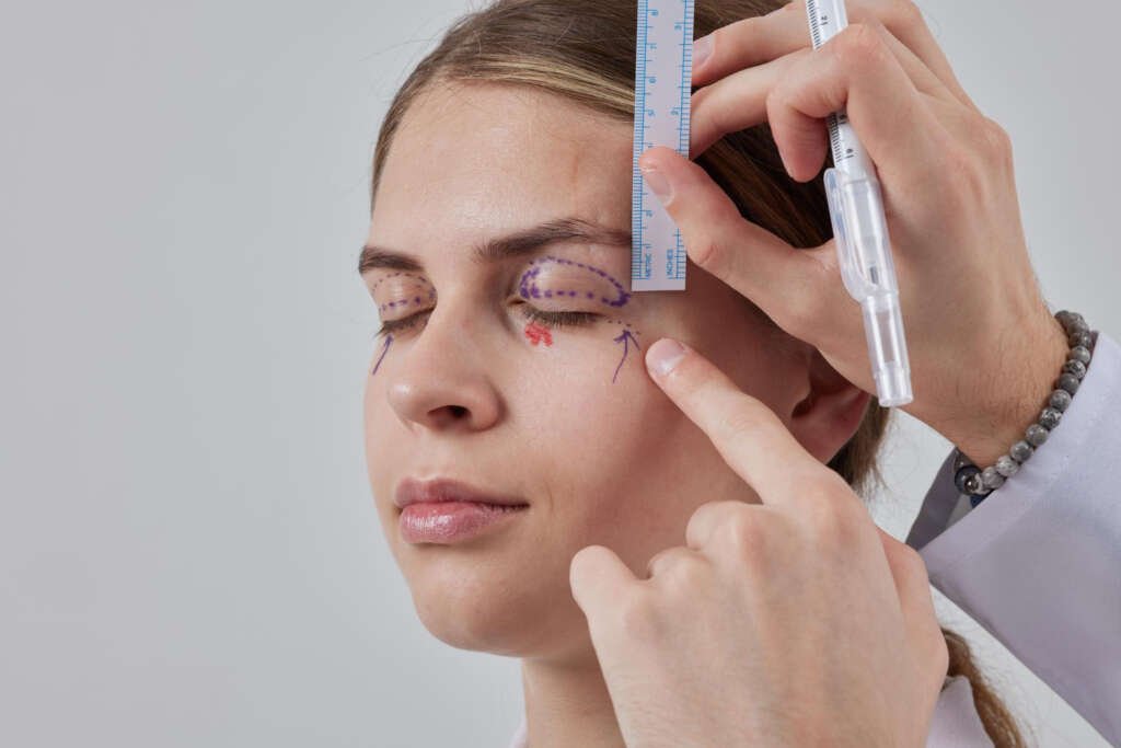 Blepharoplasty1