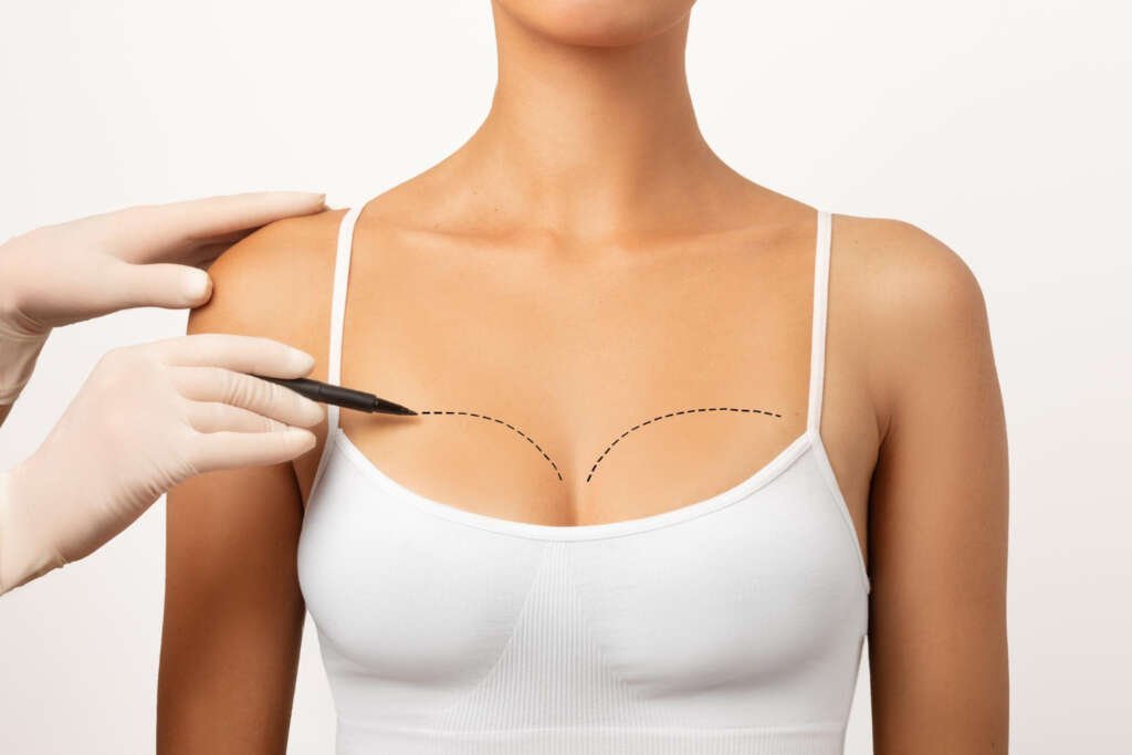 Breast Lift