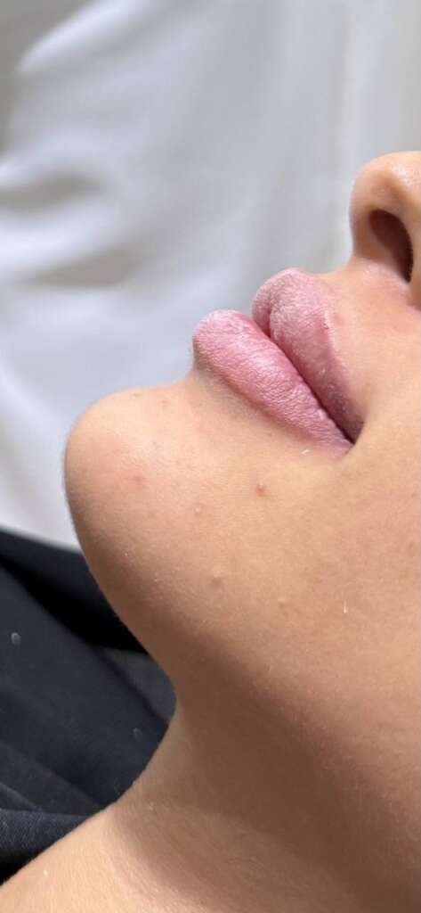 Lip filler before and after result showing enhanced lip volume, shape, and definition in Lebanon