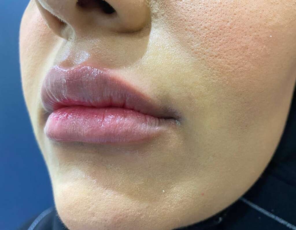 Lip filler before and after result in Lebanon