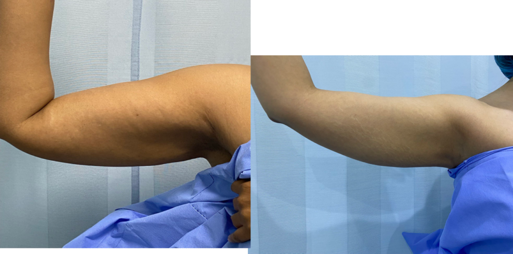 Arm lift before and after result in Lebanon