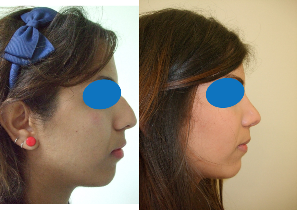 Rhinoplasty before and after result showing improved nose shape, balance, and facial harmony in Lebanon