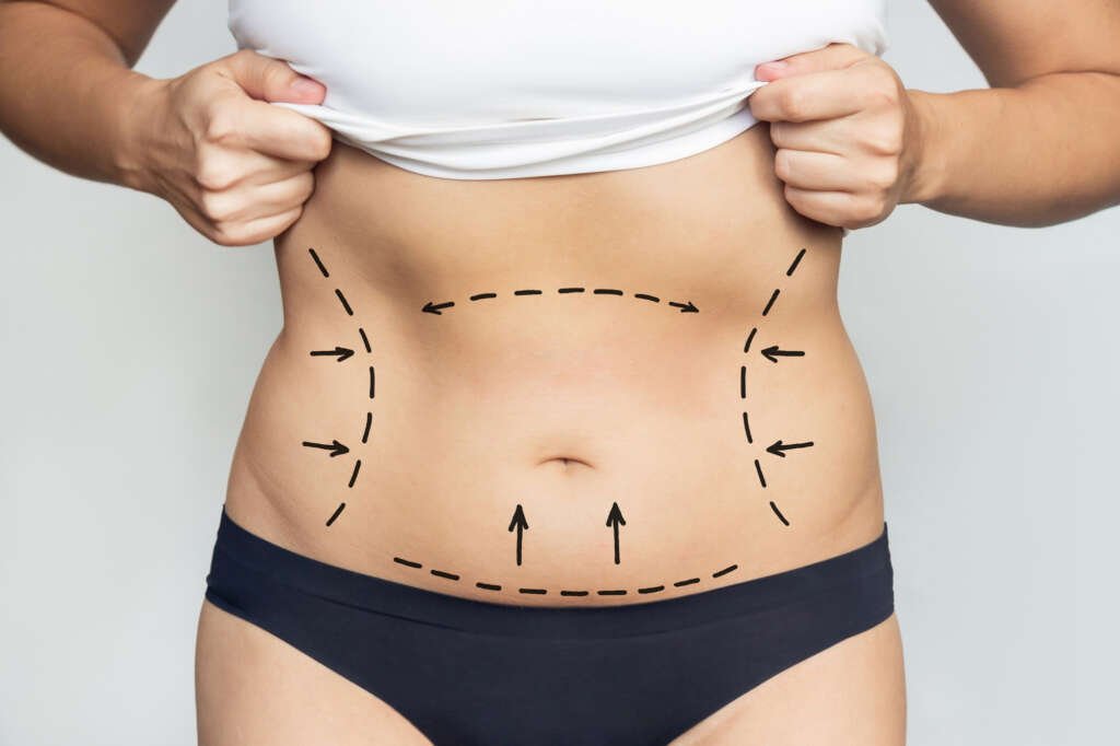 Tummy Tuck Article