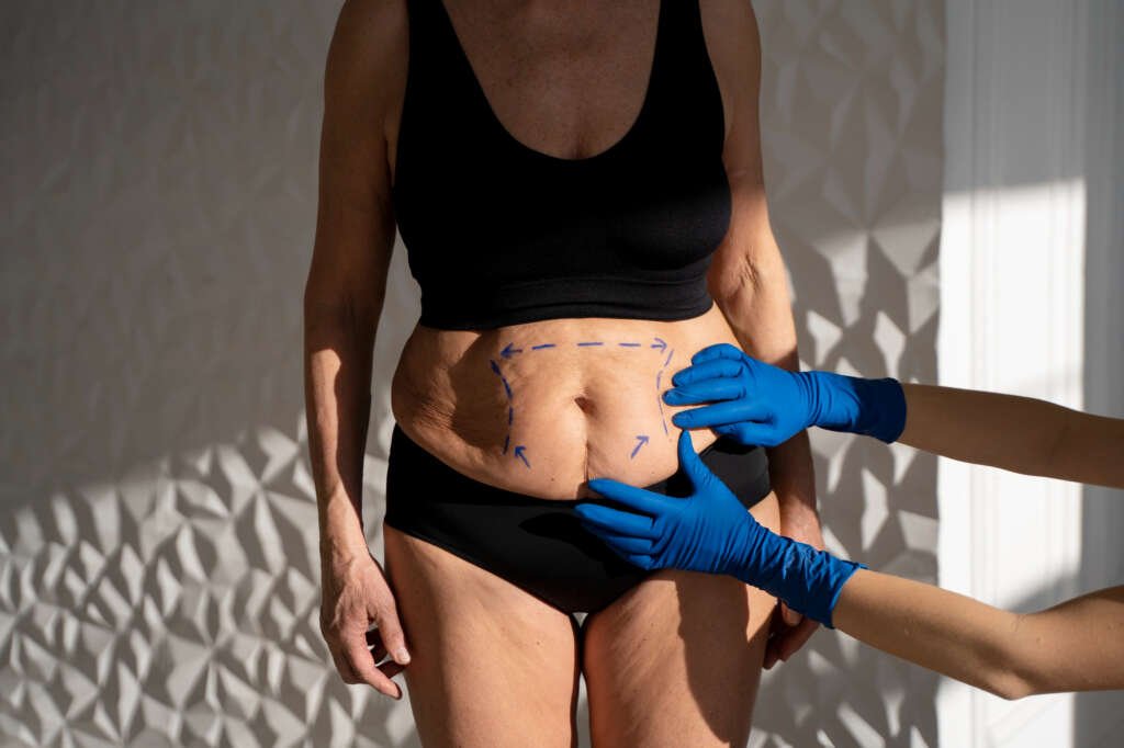 Tummy Tuck & Lipo Article