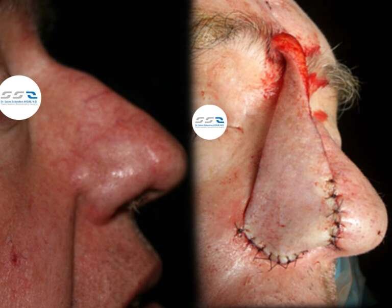 Skin surgery treatment by Dr. Salim AYOUB in Lebanon