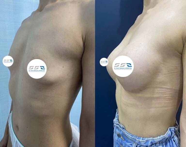 Breast augmentation before and after result by Dr. Salim AYOUB in Lebanon