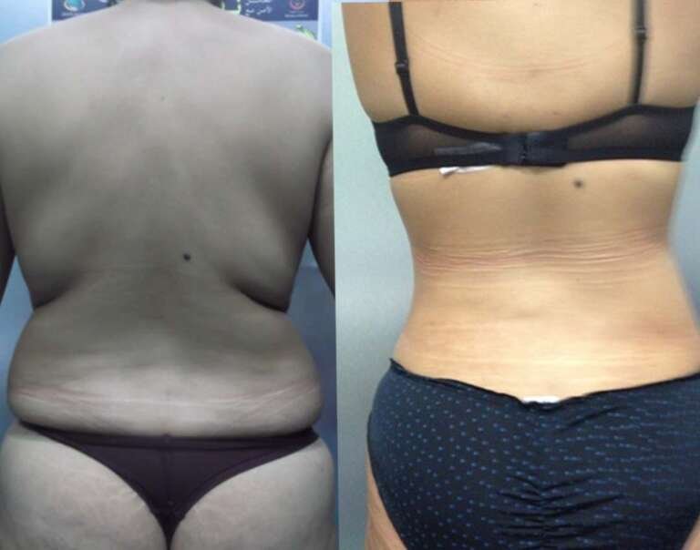 Liposuction before and after result showing improved body contour by Dr. Salim AYOUB in Lebanon