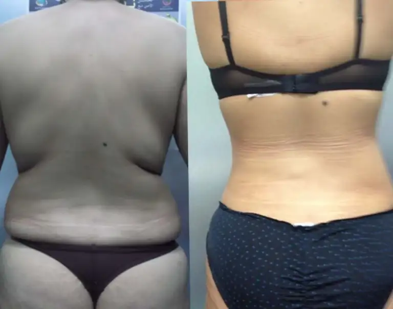 Mommy Makeover before and after showing improved abdominal and breast contour in Lebanon