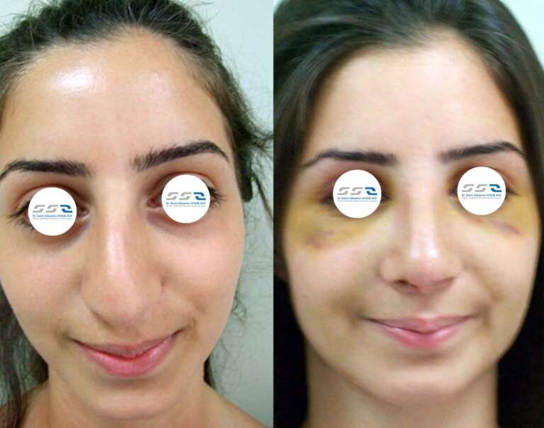 Natural rhinoplasty before and after result by Dr. Salim AYOUB in Lebanon