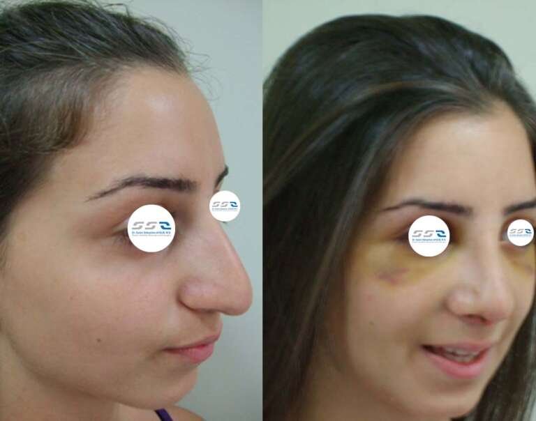 Rhinoplasty before and after result showing improved nose shape and facial balance in Lebanon
