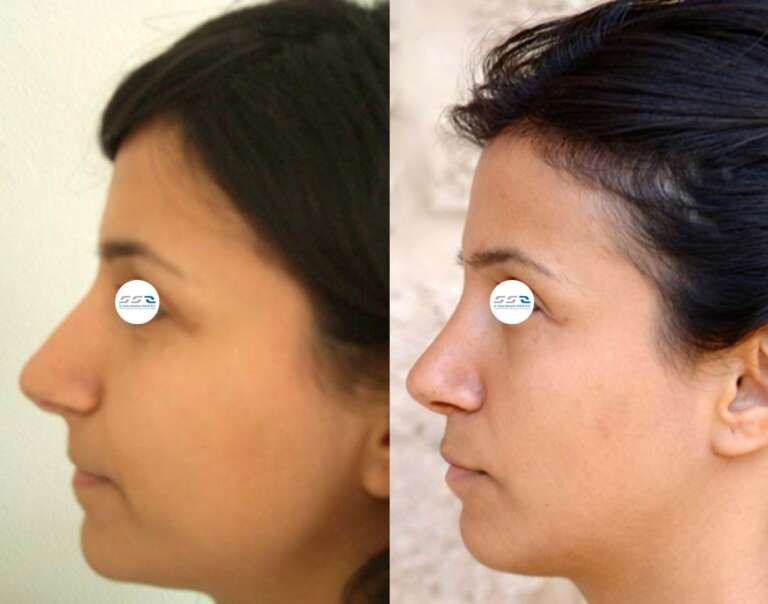 Nose reshaping rhinoplasty before and after by Dr. Salim AYOUB in Lebanon