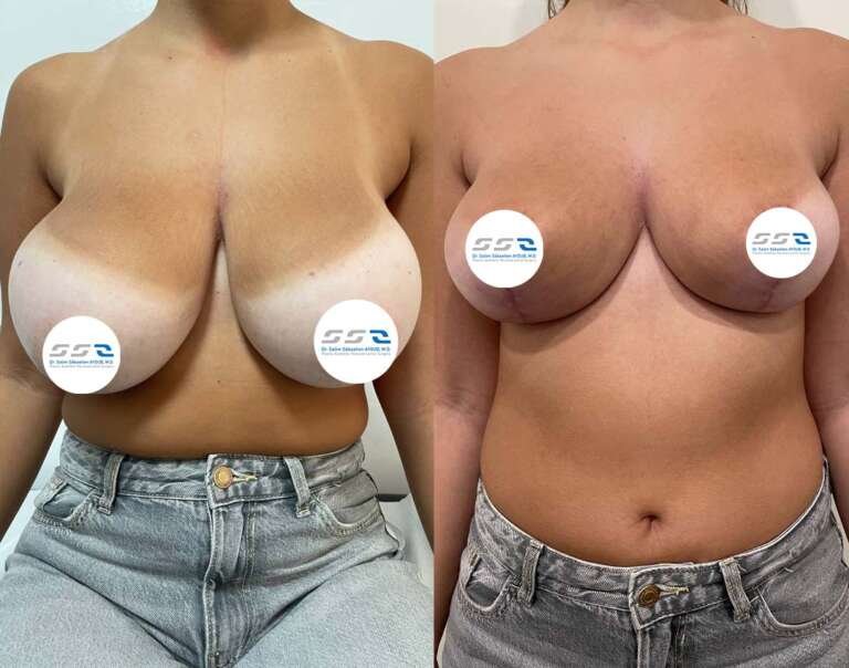 Breast lift surgery before and after with improved breast contour by Dr. Salim AYOUB