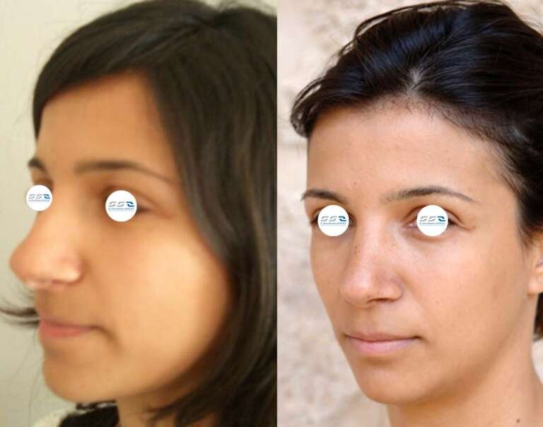 Rhinoplasty surgery before and after result with improved nasal contour in Lebanon