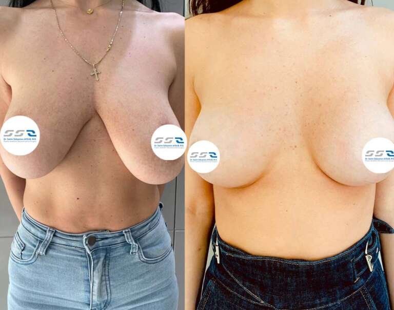 Breast lift before and after result for sagging breast correction in Lebanon