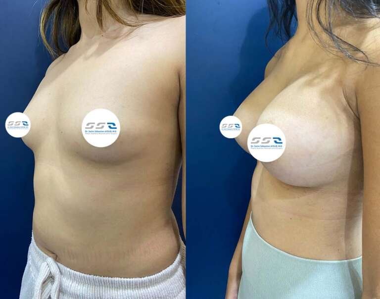 Breast implant before and after result showing improved breast shape and symmetry in Lebanon