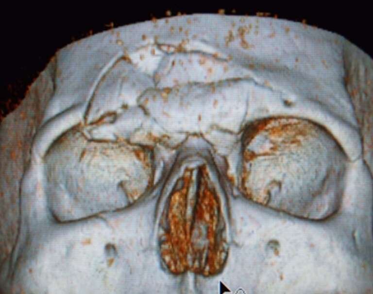 Maxillofacial reconstructive surgery by Dr. Salim AYOUB in Lebanon