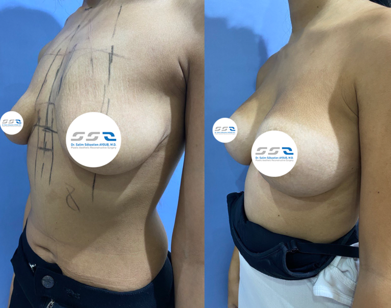 Natural breast augmentation before and after result by Dr. Salim AYOUB in Lebanon