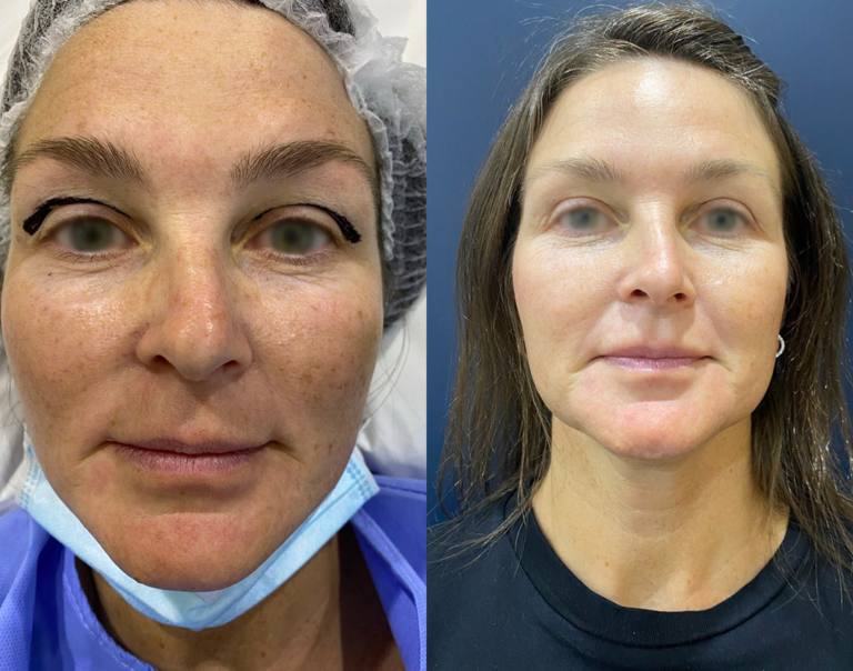 Blepharoplasty before and after result by Dr. Salim AYOUB in Lebanon, serving patients from Beirut, Jounieh, Kaslik, Jbeil and Batroun
