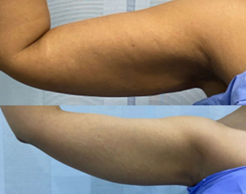 Brachioplasty before and after result by Dr. Salim AYOUB in Lebanon