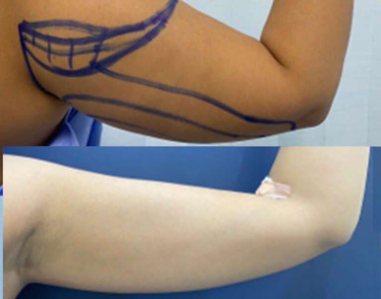 Arm lift before and after result showing improved upper arm contour in Lebanon