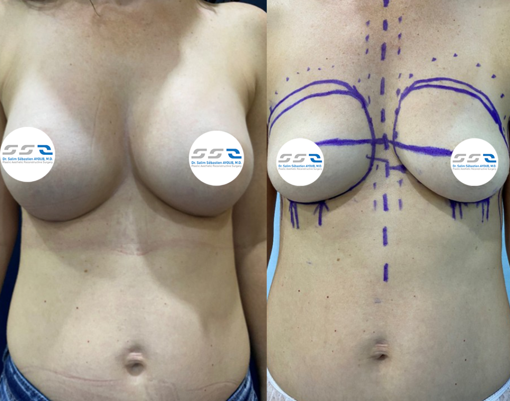 Breast implant before and after result showing improved breast shape and volume in Lebanon