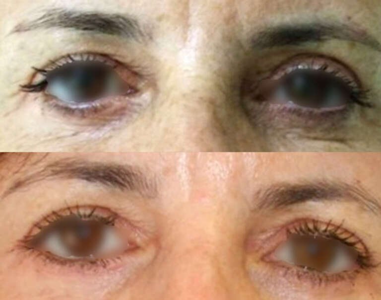 Eyelid surgery before and after result showing improved upper eyelid contour in Lebanon