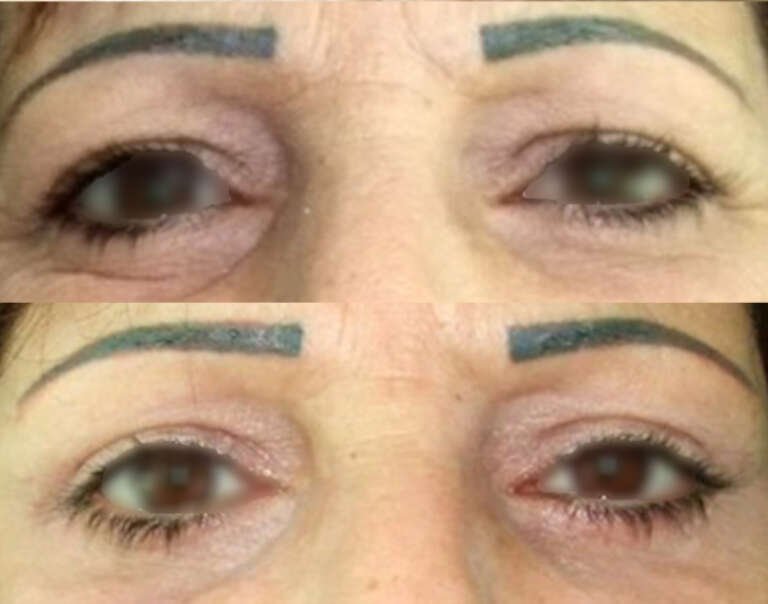 Upper and lower blepharoplasty before and after result by Dr. Salim AYOUB in Lebanon