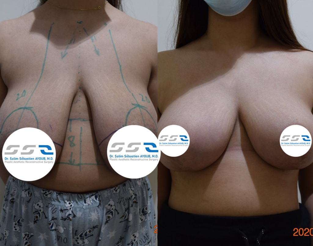 Breast lift before and after result showing improved breast position and contour in Lebanon