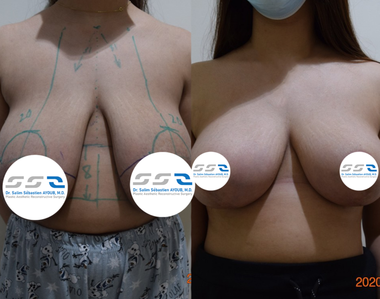 Breast lift before and after result showing improved breast position and contour in Lebanon