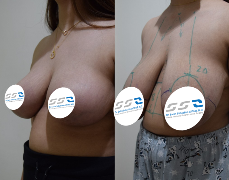 Mastopexy before and after result with improved breast shape by Dr. Salim AYOUB in Lebanon