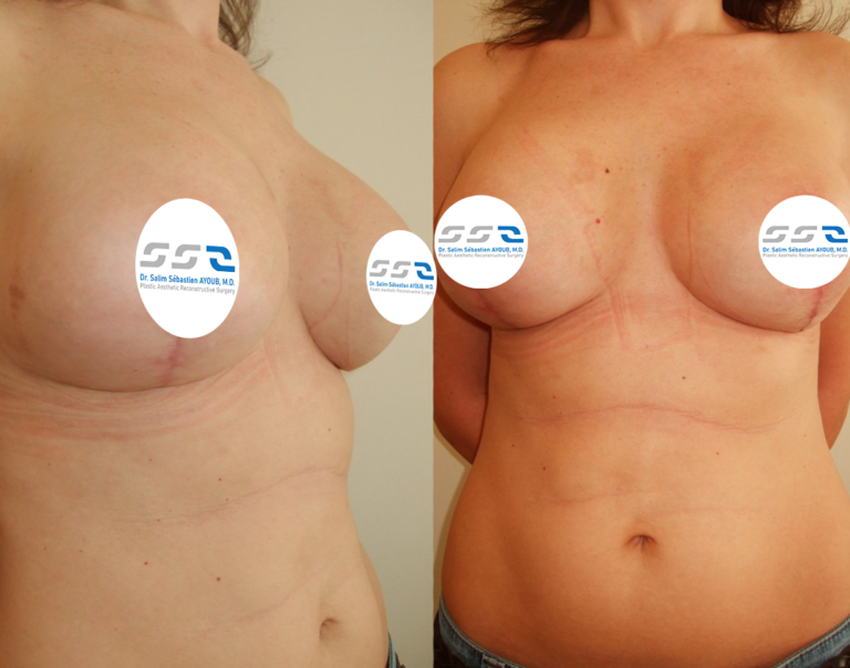 Breast reconstruction before and after result by Dr. Salim AYOUB in Lebanon
