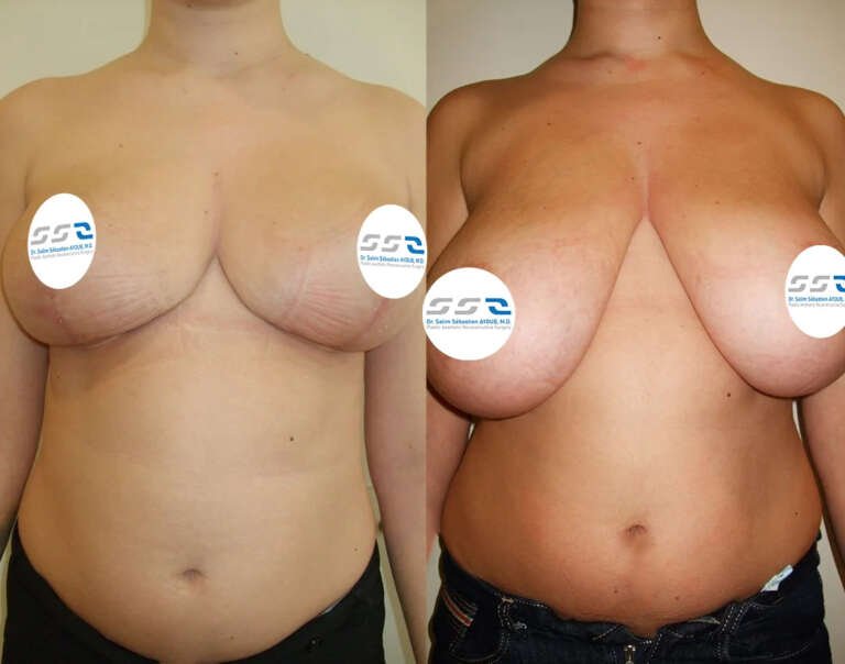 Breast reduction before and after result showing improved breast size, shape, and proportion in Lebanon
