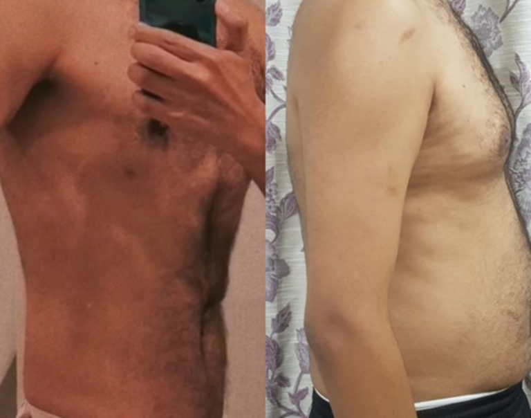Male breast reduction before and after result by Dr. Salim AYOUB in Lebanon