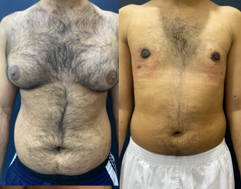 Gynecomastia male breast reduction before and after result in Lebanon