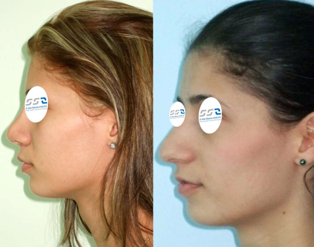 Rhinoplasty before and after result showing improved nose shape and facial balance in Lebanon