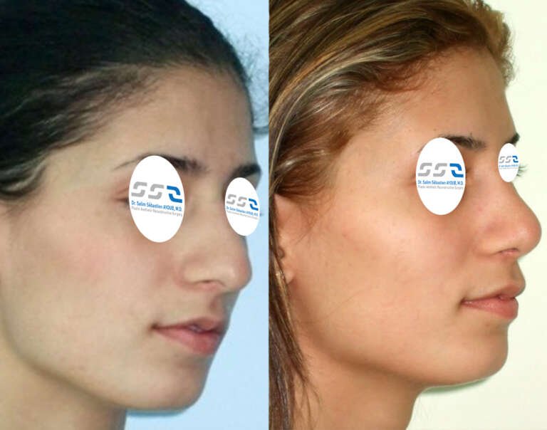 Nose reshaping rhinoplasty before and after result by Dr. Salim AYOUB in Lebanon