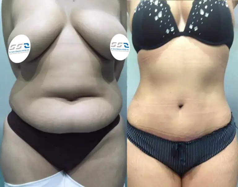Post-pregnancy Mommy Makeover surgery result by Dr. Salim AYOUB in Lebanon