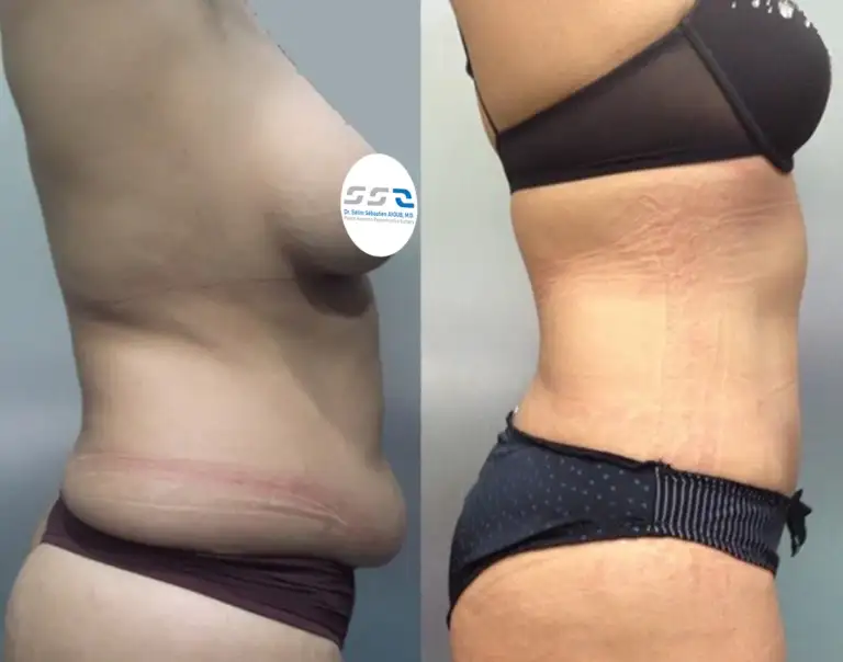 Mommy Makeover before and after result by Dr. Salim AYOUB in Lebanon