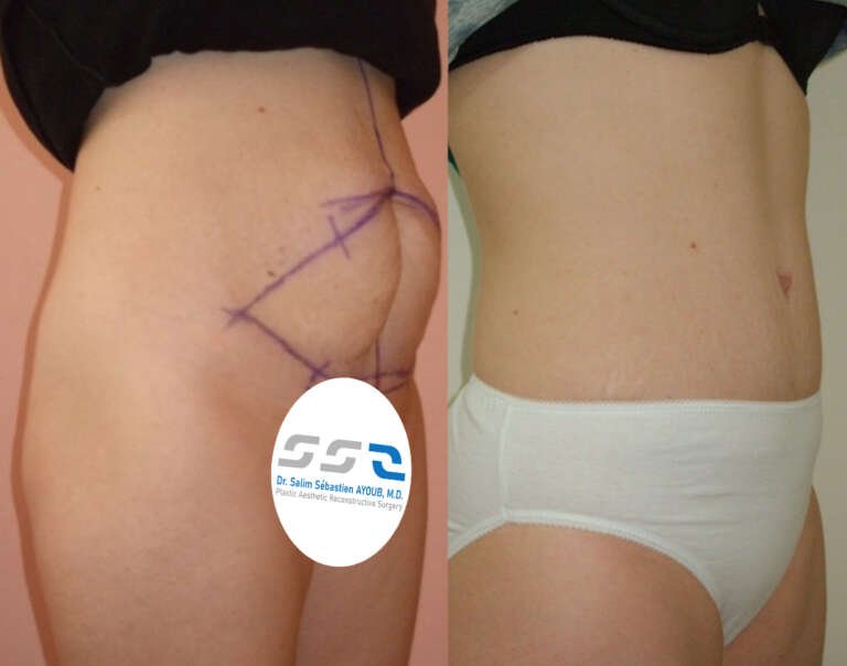 Tummy tuck before and after result showing improved abdominal contour in Lebanon