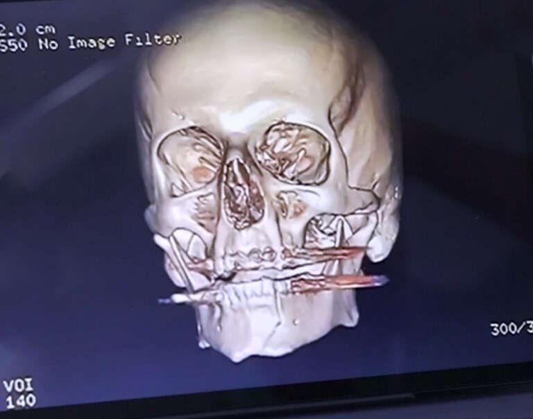 Maxillofacial reconstructive surgery before and after result by Dr. Salim AYOUB in Lebanon