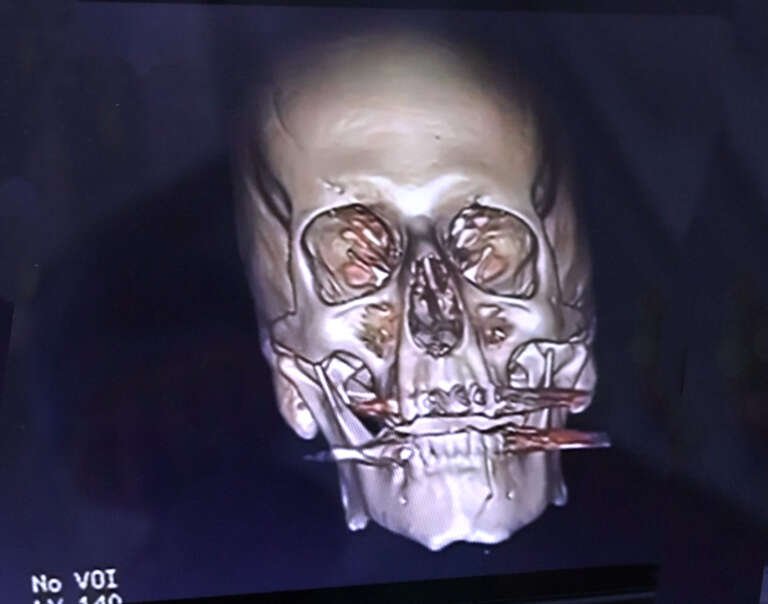Facial reconstruction maxillofacial surgery result in Lebanon by Dr. Salim AYOUB